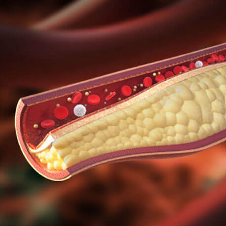 About Blood Cholesterol - We Cure Blood Cholesterol By Naturopathy Treatment